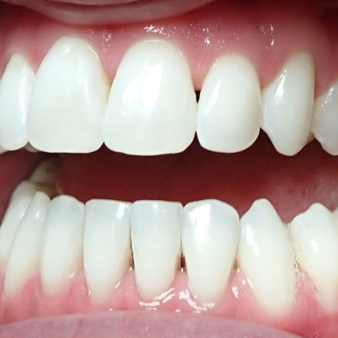 After Zoom whitening