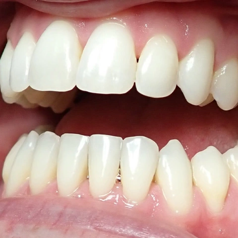 Before Zoom whitening